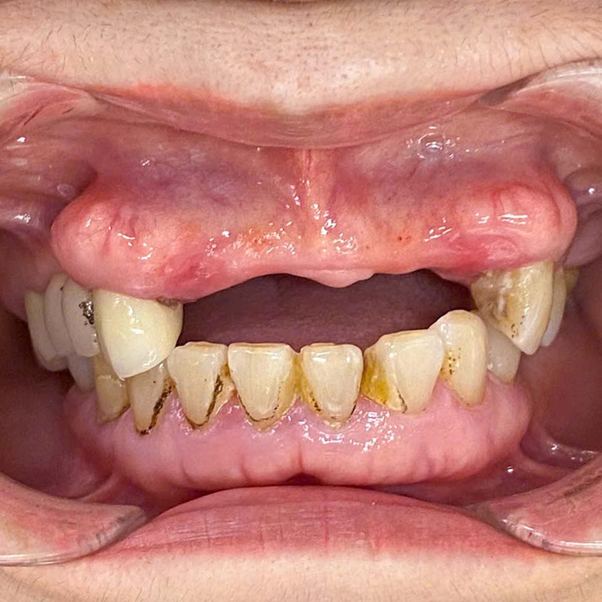 Tình trạng răng Cô Liên ban đầu