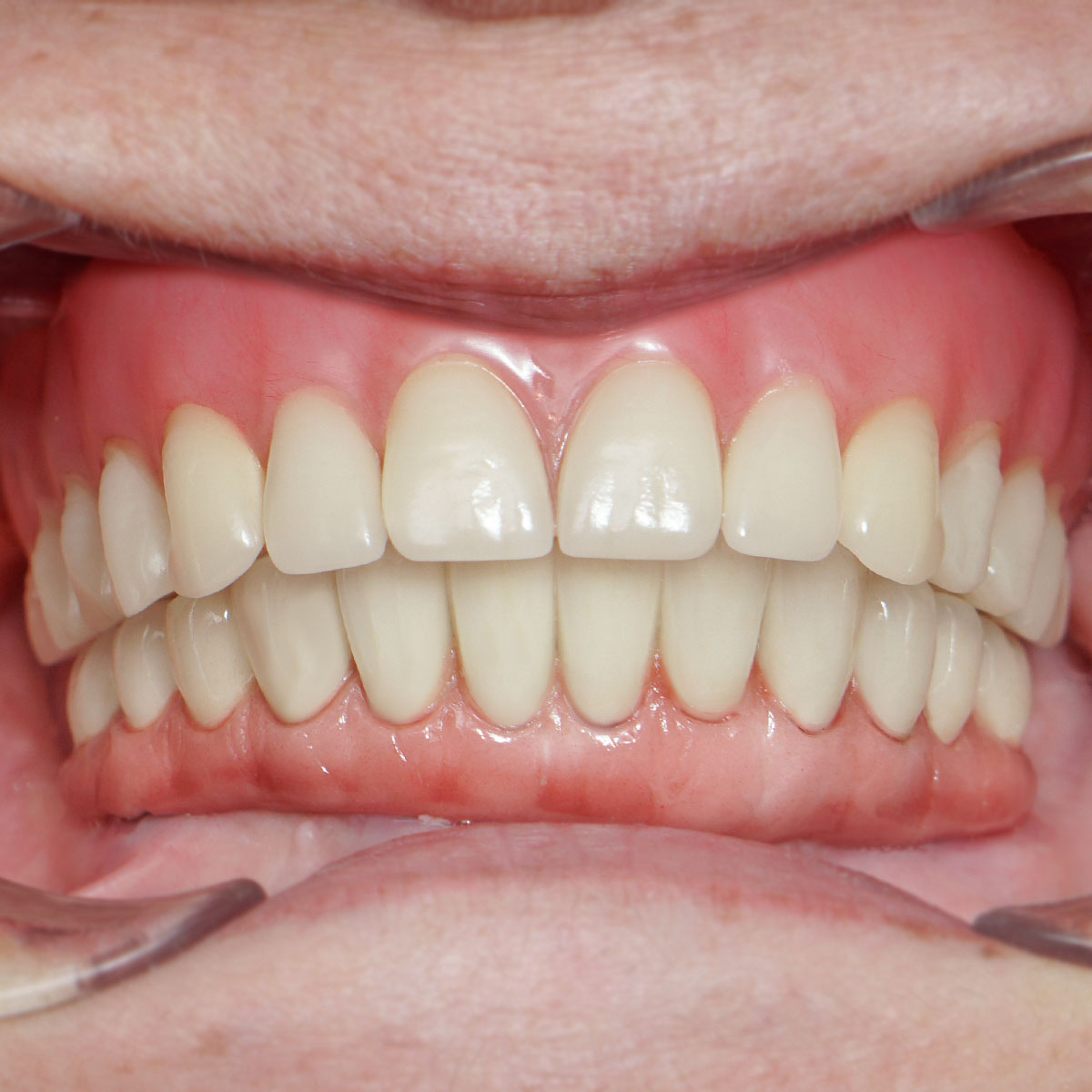 Kết quả trồng răng Cô Liên