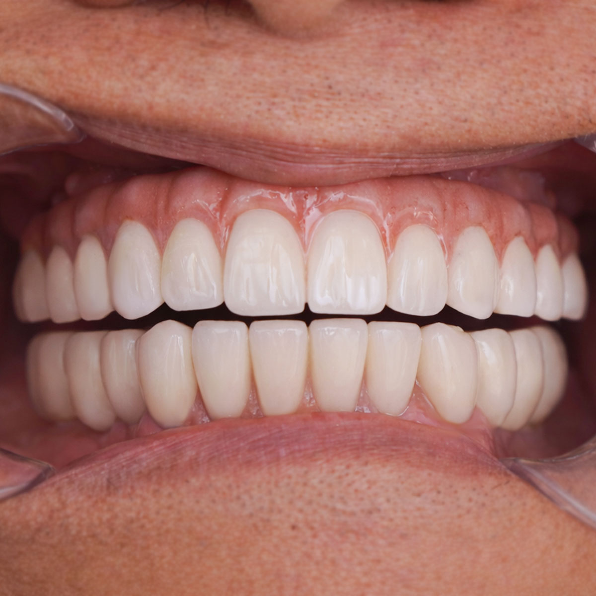 Kết quả trồng răng Chú Tony