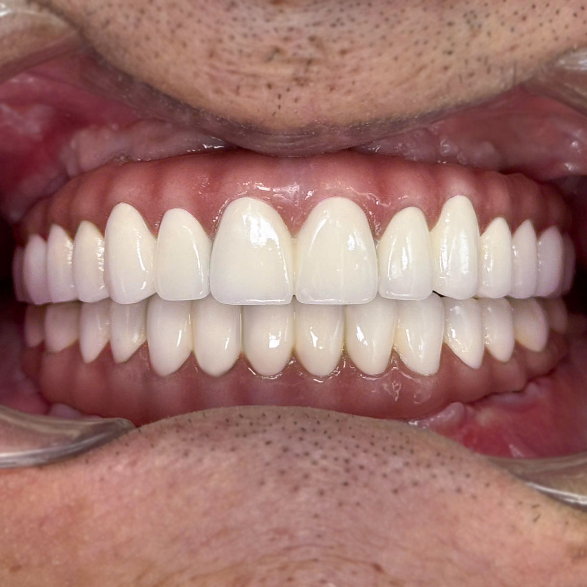 Kết quả trồng răng Chú Tuyền